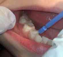 Fluoridácia zubov u detí - záruka zdravého uhryznutia
