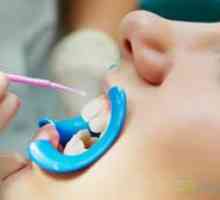 Fluoridácia zubov u detí: dávka, cena
