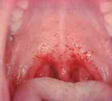 Herpes stomatitis u detí: príznaky a liečba