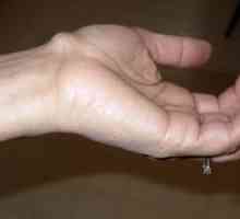 Hygroma na zápästie: príčiny a liečba