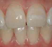 Hypoplázia skloviny zubov dieťaťa: zuby fernier