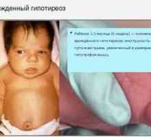 Hypotyreóza u detí: príznaky, príčiny, liečba