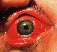 Očná masť z konjunktivitídy u dieťaťa a dospelých