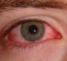 Očné masti na konjunktivitídu pre deti