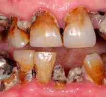 Zhnité zuby u dieťaťa a dospelého: prečo zuby začnú hniť