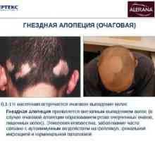 Alopecia areata u žien a jej liečba