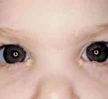 Hnisavý výtok z očí, príčiny, hnis do novorodenca