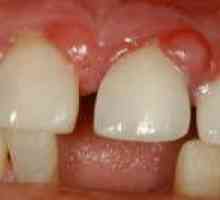 Zubný granulóm: Príznaky a liečba chorôb