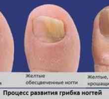 Huba na nechty nohy: príčiny a symptómy