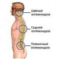 Chondroza krčnej chrbtice: príznaky a liečba