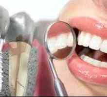 Implantácia zubov pod kľúčom: cena implantácie zuba pod kľúčom