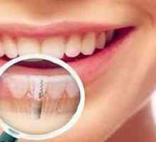 Implantácia zubov: podstatou postupu pre vytvorenie zubného implantátu