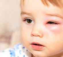 Jačmeň na oči dieťaťa: dôvody, ako liečiť