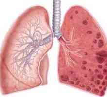 Emfyzém pľúc - čo je to a prognóza života
