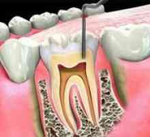 Endodontická stomatológia v zubnom lekárstve: čo to je?