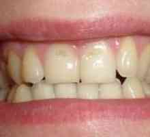 Erozia zubnej skloviny: príčiny, príznaky, liečba