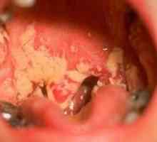 Ako sa zbaviť drozdov v ústach dospelého?