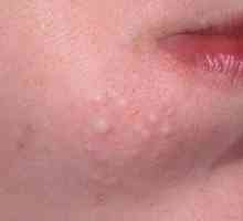 Ako sa zbaviť podkožného akné na tvári