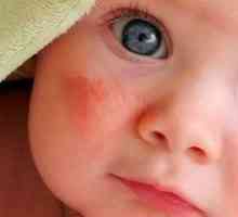 Ako liečiť alergiu u dieťaťa Komarovského