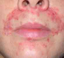 Ako liečiť dermatitídu na tvári: spôsoby, fotky choroby