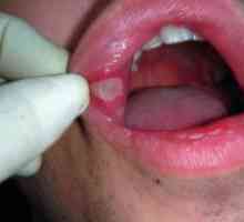 Ako liečiť zápal ústnej sliznice: prostriedky a spôsoby liečby