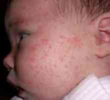 Ako sa prejavuje alergia na potravu u dieťaťa, ako na liečbu vyrážky na tvári