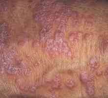 Ako liečiť červený lichen planus: spôsoby a fotky choroby