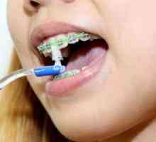 Aké sú zárezy pre zuby a ako ich dať