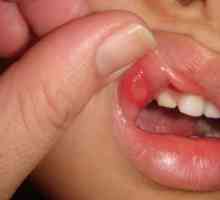Aký liek si môžete vybrať zo stomatitídy v ústach?