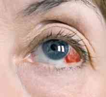 Jodid draselný: pokyny na používanie jódových očných kvapiek