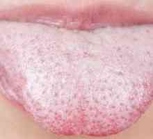 Kandidóza ústnej dutiny: liečba úst u dospelých