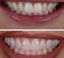 Keramická podšívka pre zuby: popis a indikácie