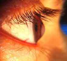 Keratokonus oka: konzervatívna a chirurgická liečba