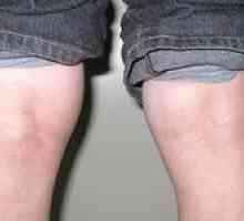 Beckerova cysta pod kolenom - ako nebezpečné a ako sa liečiť?