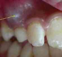 Cyst na koreň zubu: všetky metódy odstránenia