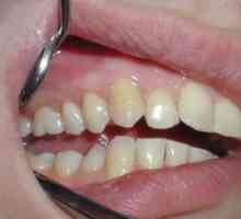 Cyst na zub: príčiny, symptómy a liečba choroby