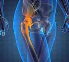 Koxartróza bedrového kĺbu: symptómy a liečba