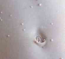 Molluscum contagiosum na koži dieťaťa: liečba a fotografie
