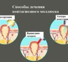 Molluscum contagiosum na koži dieťaťa: príznaky, diagnóza, liečba