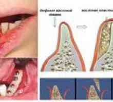 Kostná plasticita pre implantáciu zubov: popis a cena