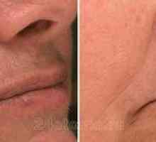 Laserové odstránenie chĺpkov na tvári u žien
