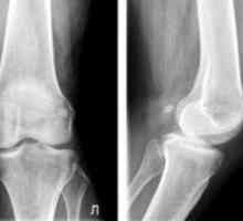 Liečba artrózy kolenného kĺbu 1 stupeň