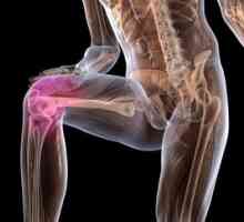 Liečba artrózy kolenného kĺbu doma