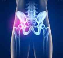 Liečba artrózy bedrového kĺbu