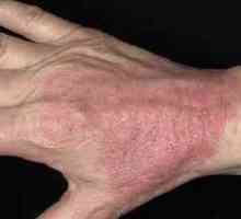 Liečba atopickej dermatitídy u dospelých