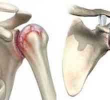 Liečba deformujúcej artrózy ramenného kĺbu
