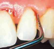 Liečba guma v zubnom lekárstve a možné choroby