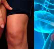 Liečba gonartrózy kolenného kĺbu 2. stupňa: príznaky ochorenia