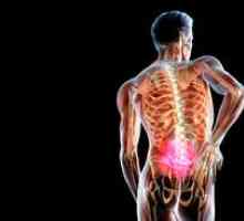 Liečba chrbticových hernií bez operácie