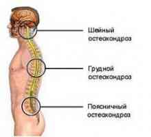 Liečba a príznaky osteochondrózy hrudnej chrbtice